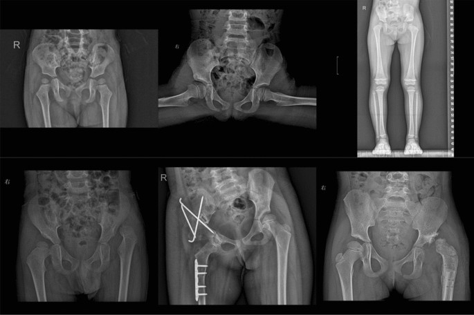Ray and PyTorch are finally under one roof. Good riddance to the anxiety.